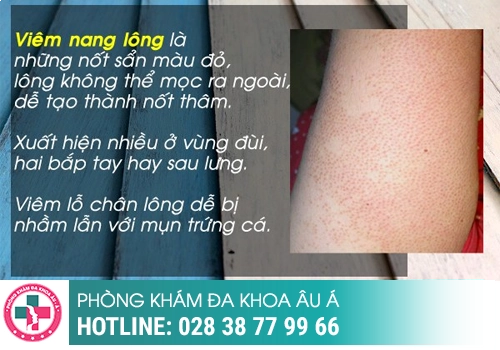 Cách chữa mụn vùng kín 