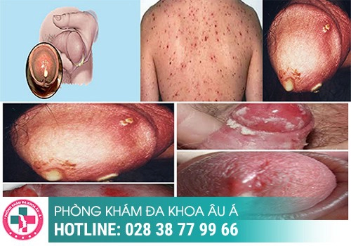  Phương pháp sử dụng thuốc Tây y điều trị bệnh lậu