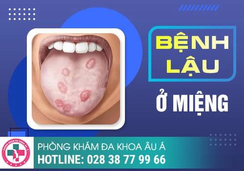 Bệnh lậu ở miệng 