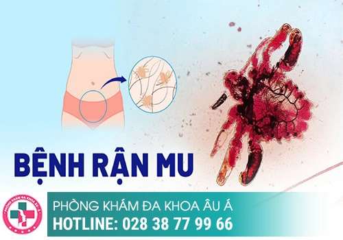 Những điều cần biết về bệnh rận mu