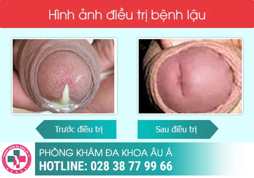 Điều trị bệnh lậu bao lâu thì khỏi?