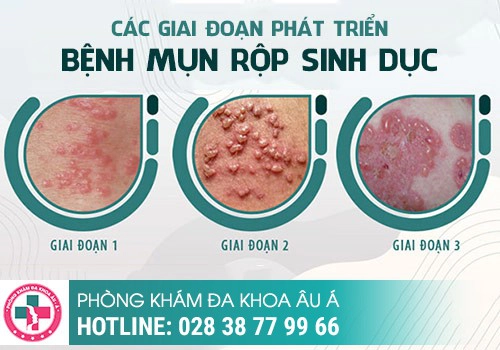 Nguyên nhân gây ra mụn rộp sinh dục