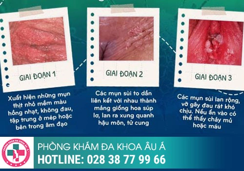 Sùi mào gà nữ