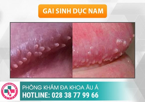gai sinh dục