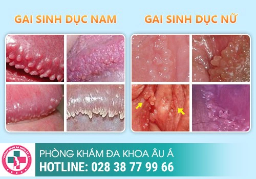 phân biệt sùi mào gà và gai sinh dục