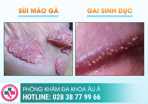 hình ảnh gai sinh dục