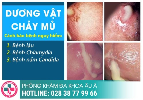 Chảy mủ niệu đạo có phải mắc bệnh lậu không?