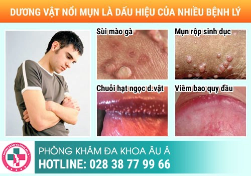 Dấu hiệu nhận biết chảy mủ niệu đạo