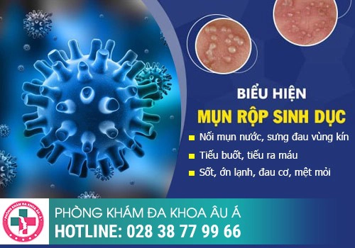 chữa mụn rộp sinh dục tại nhà