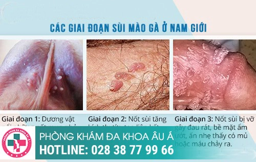 Sùi mào gà dương vật – bệnh nguy hiểm, khó đề phòng