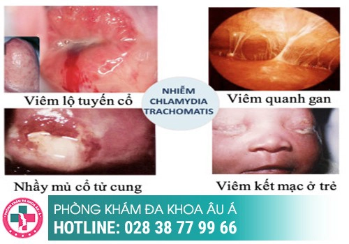 bệnh lây qua đường quan hệ tình dục