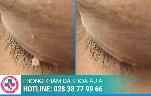 Phương pháp đốt điện công nghệ mới