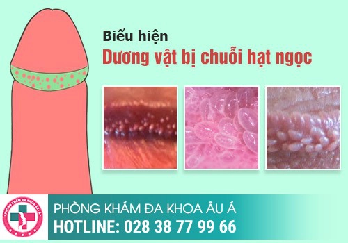 Chuỗi hạt ngọc quanh bao quy đầu là gì?