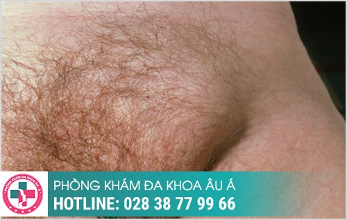 hình ảnh nổi hạch ở bẹn háng