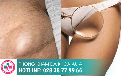 hình ảnh nổi hạch ở bẹn háng