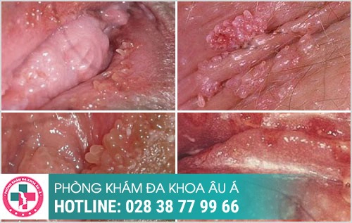 mọc mụn thịt ở môi lớn môi bé
