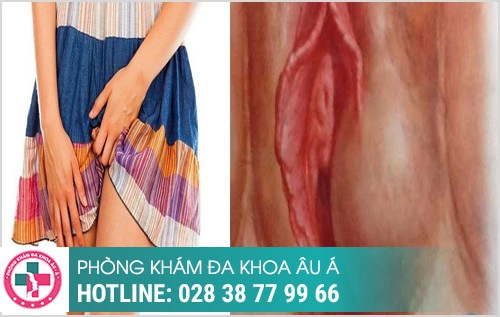nỗi hạch ở vùng kín nữ có sao không