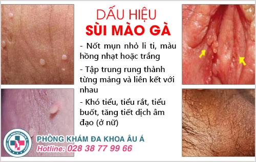 phòng khám sùi mào gà