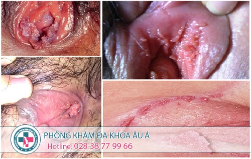 Điều trị sùi mào gà