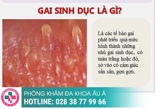 Thuốc chữa gai sinh dục tại nhà được nhiều người dùng