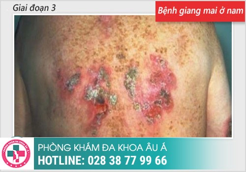Chi tiết hình ảnh bệnh giang mai ở nam, nữ qua từng giai đoạn