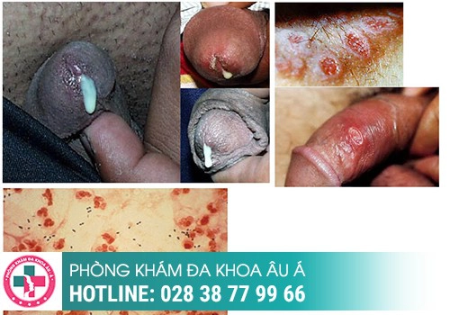 Hình ảnh bệnh lậu ở nam