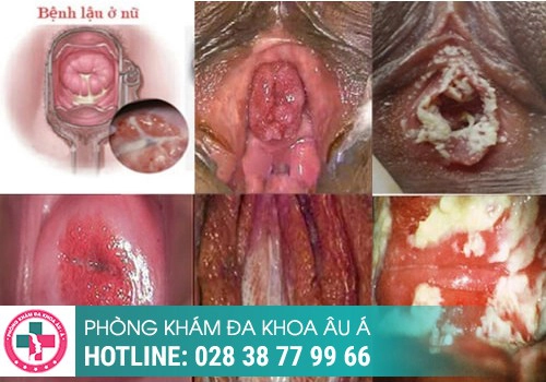 Hình ảnh về bệnh lậu ở nữ giới 