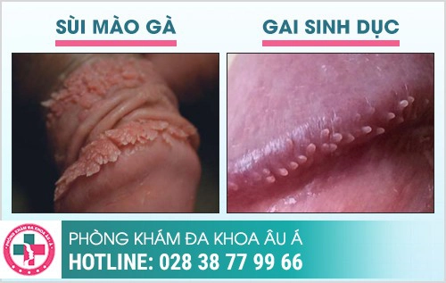 Nhận biết sùi mào gà và gai sinh dục