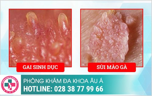 Nhận biết sùi mào gà và gai sinh dục