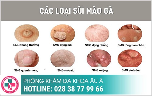 Cách nhận biết sùi mào gà, Nhận biết sùi mào gà bằng cách nào