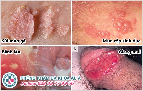 các bệnh viêm nhiễm dương vật