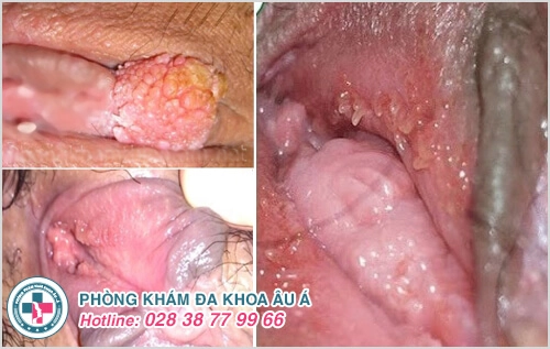 biểu hiện sùi mào gà