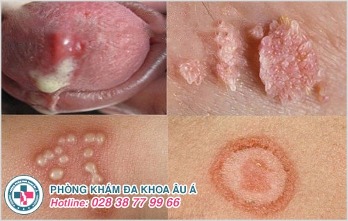 Các bệnh lây qua đường tình dục