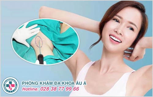 Cắt tuyến mồ hôi nách liệu có phải là giải pháp an toàn?