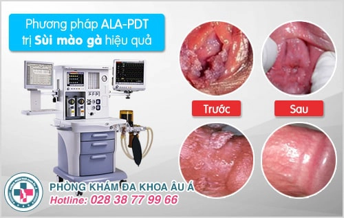 Khi mắc bệnh sùi mào gà ở họng phải làm sao?