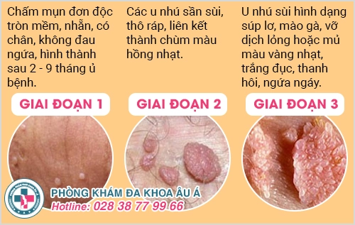 Dùng thuốc trị virus HPV có hiệu quả không?