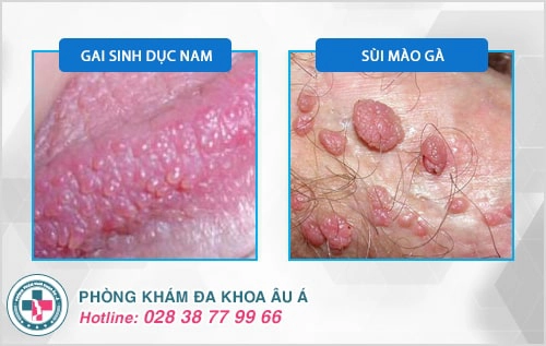 gai sinh dục