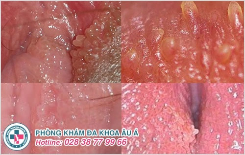 Hình ảnh gai sinh dục ở nữ
