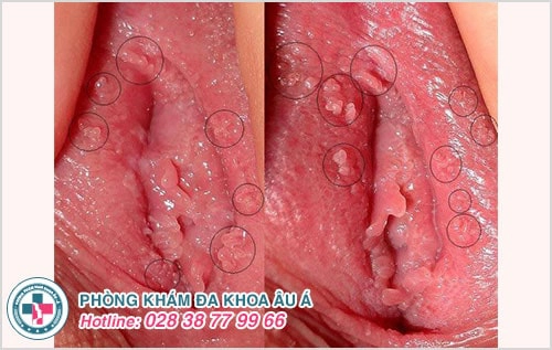 Hình ảnh gai sinh dục ở nữ