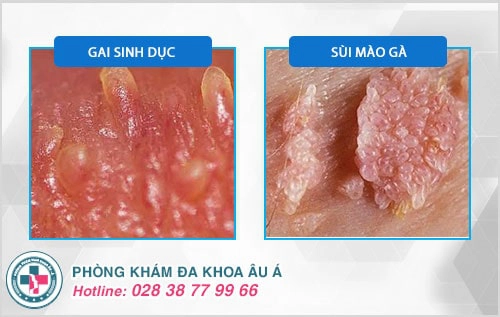 Hình ảnh gai sinh dục ở nữ