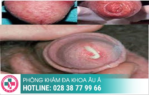 hình ảnh bệnh lậu ở nam giới