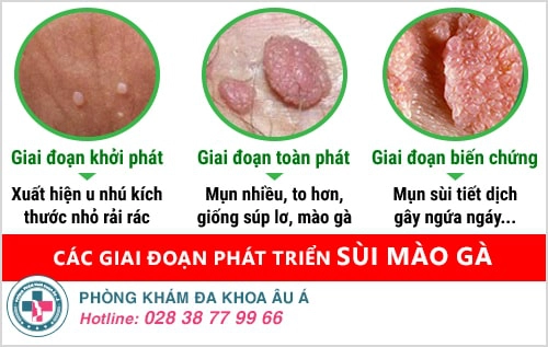 khám sùi mào gà ở đâu