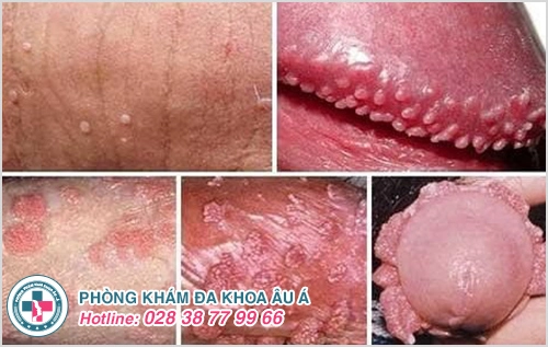 mụn dương vật