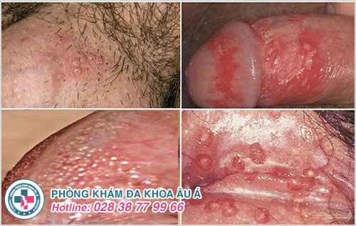 Mọc mụn ở dương vật quý ông chớ xem thường