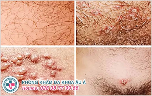 Nổi mụn nước ở bộ phận sinh dục là dấu hiệu của bệnh gì?