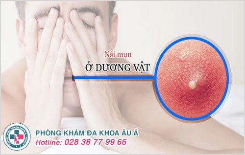 Mọc mụn ở dương vật quý ông chớ xem thường