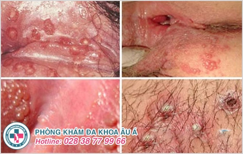 Hình ảnh vùng kín nổi mụn
