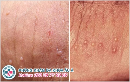 Chi tiết hình ảnh và biểu hiện sùi mào gà giai đoạn đầu