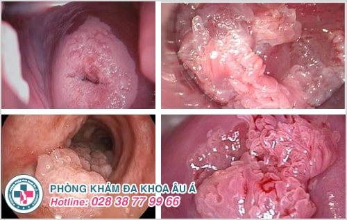 sùi mào gà ở âm đạo