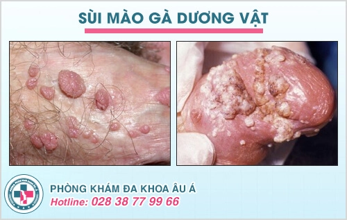 sùi mào gà ở nam giới